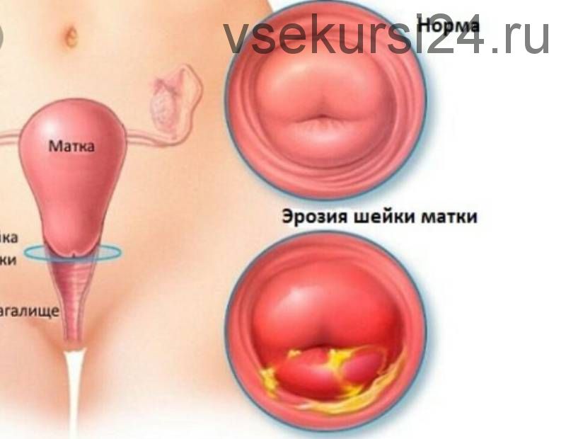 Эрозия шейки матки. Лечить или не лечить? (Ирина Жгарёва)